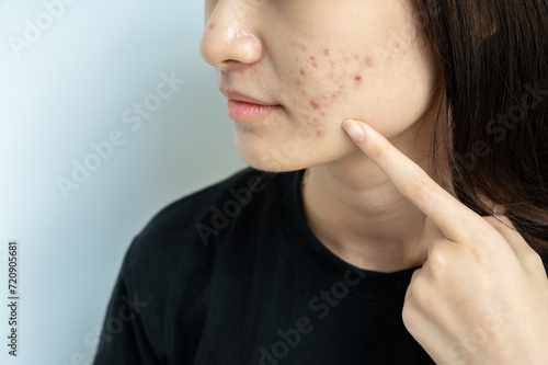 Cropped shot of woman pointing to acne problem on her cheek. Inflamed acne consists of swelling  redness  and pores that are deeply clogged with bacteria  oil  and dead skin cells.