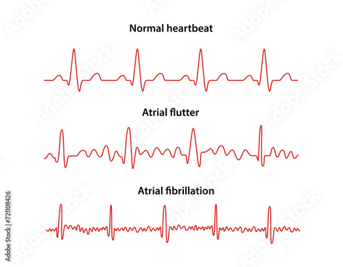 Diagram of normal rhythm, Atrial flutter and Atrial fibrillation for a human heart. Heart cardiogram. Vector illustration in flat style isolated on white background photo