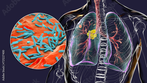 Primary lung tuberculosis, 3D illustration photo