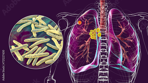 Primary lung tuberculosis, 3D illustration