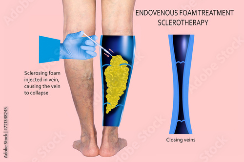 Obraz na płótnie Endovenous laser treatment for varicose veins - foam sclerotherapy concept. w salonie