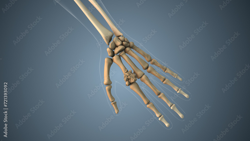 Cancer spreading along a hand finger bone