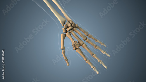 Cancer spreading along a hand finger bone