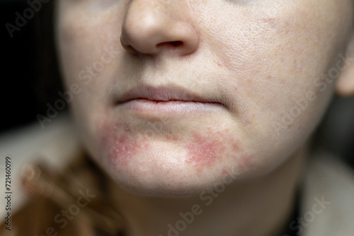 Perioral dermatitis on woman face. Closeup dermatitis on skin, ill allergic rash eczema skin of patient, atopic dermatitis symptom skin detail texture. The concept dermatology photo