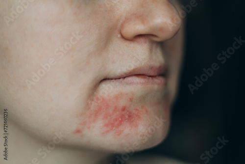 Perioral dermatitis on woman face. Closeup dermatitis on skin, ill allergic rash eczema skin of patient, atopic dermatitis symptom skin detail texture. The concept dermatology