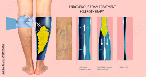 Endovenous laser treatment for varicose veins - foam sclerotherapy concept. photo