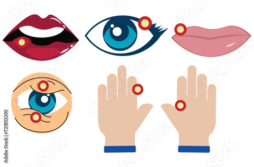 angioedema,Anaphylaxis allergy, swollen lips,eye,hand and bee sting the Epinephrine drug dose adrenaline of allergen nut syringe treat life threatening in septic heart failure,five