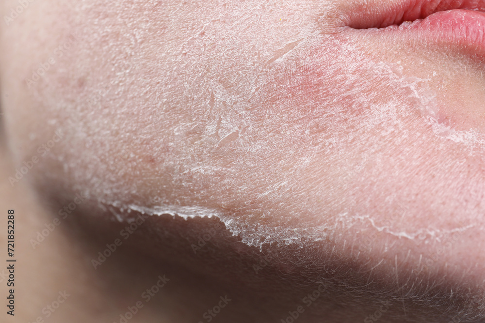 Fototapeta premium Woman with dry skin on face, closeup