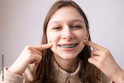 Young teen girl with abnormal teeth position and correction with metal braces. Open mouth close up.