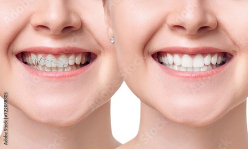 Young woman smiling before and after teeth treatment.