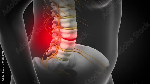Back Pain, could be caused by spinal disc herniation / slipped disc. 3d animation photo