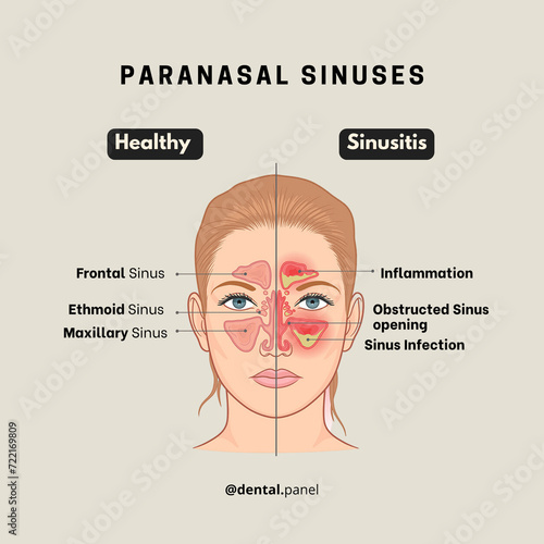 Paranasal Sinuses  photo
