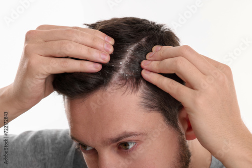 Man with dandruff in his dark hair on white background, closeup
