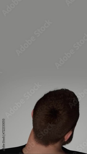 Hair transplant before after concept. hair transplant story size