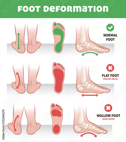 Foot deformation. Feet pathology infographics, normal position, flat and hollow feet, arch of sole, educational scheme, orthopedic medical poster, flat style isolated tidy vector concept