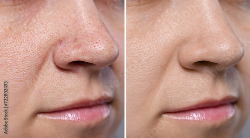 Blackhead treatment  before and after. Collage with photos of woman  closeup view