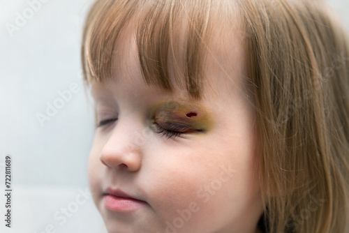 Bruising and swelling above the child's eye. Injury to the eyelid from a blow. The accident date was one or two days ago. Close-up. Soft focus.