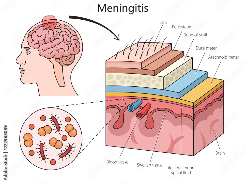 Meningitis disease diagram hand drawn schematic raster illustration