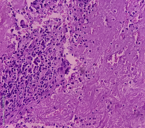 Cold abscess wall  biopsy . Chronic granulomatous inflammation  CGI  with Tuberculosis. CGI-TB. Section show multiple granulomas with Langhans  giant cells with chronic inflammatory cells.