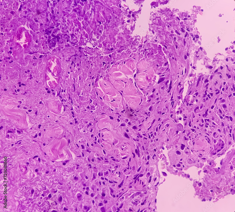 Cold abscess wall (biopsy). Chronic granulomatous inflammation (CGI) with Tuberculosis. CGI-TB. Section show multiple granulomas with Langhans' giant cells with chronic inflammatory cells.