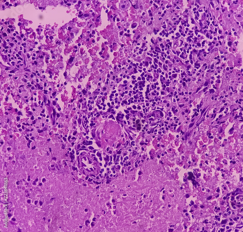 Cold abscess wall (biopsy). Chronic granulomatous inflammation (CGI) with Tuberculosis. CGI-TB. Section show multiple granulomas with Langhans' giant cells with chronic inflammatory cells. photo