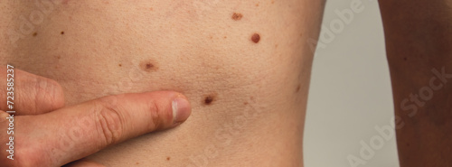 Male hand showing birthmarks on skin body stomach part. Close up detail of the bare skin. Health Effects of UV Radiation. Man with birthmarks Pigmentation