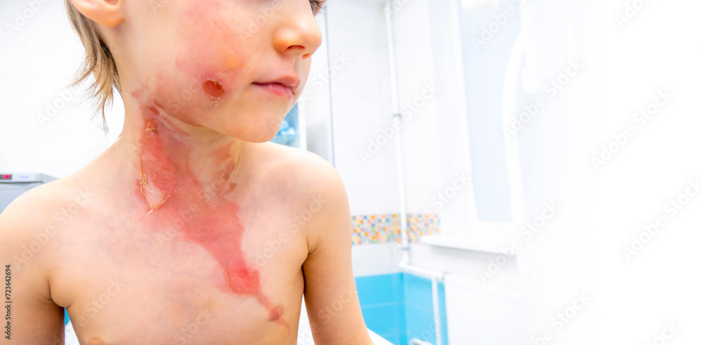 medical procedure dressing a boy with a first-degree burn from boiling water on his face, neck and chest