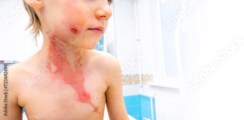 Obraz na płótnie medical procedure dressing a boy with a first-degree burn from boiling water on his face, neck and chest w salonie