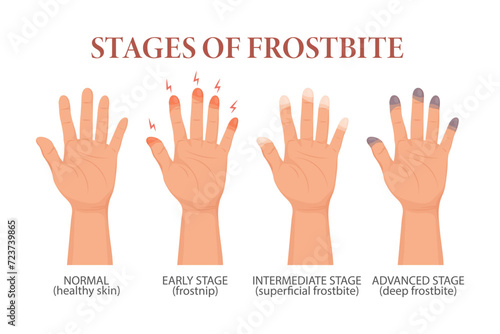 Frostbite stages. Frozen hands in different stages. Medical frostbite. Skin burn symptom. Health care medical concept. Vector