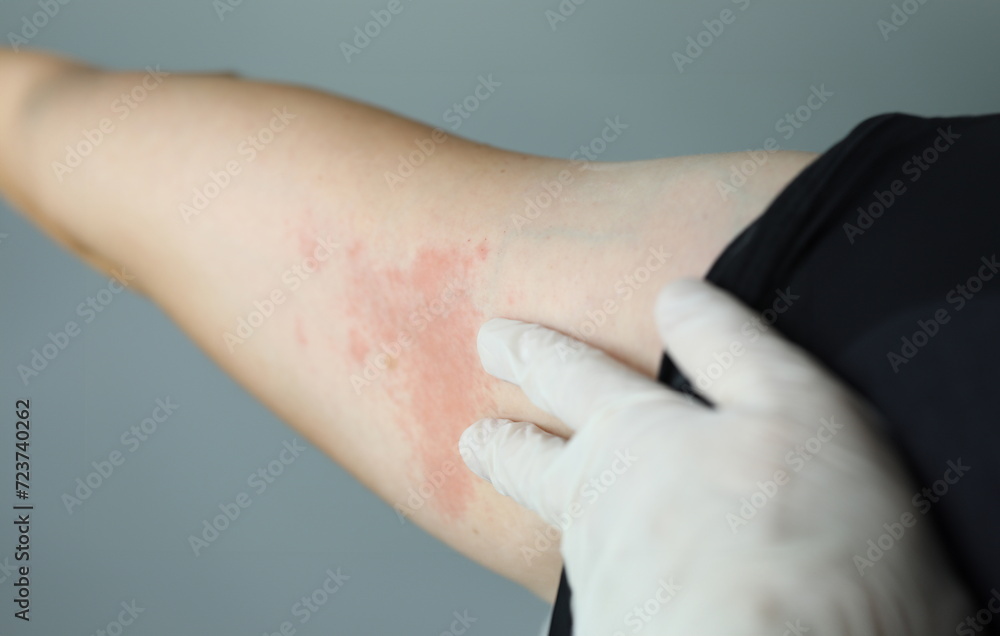 Closeup red rash on white skin hand, examination. Doctor touches an