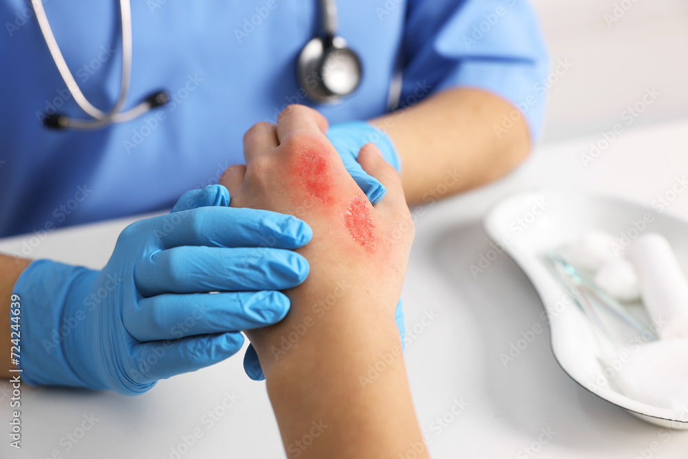 Doctor examining patient's burned hand at table, closeup Doctor examining patient's burned hand at table, closeup