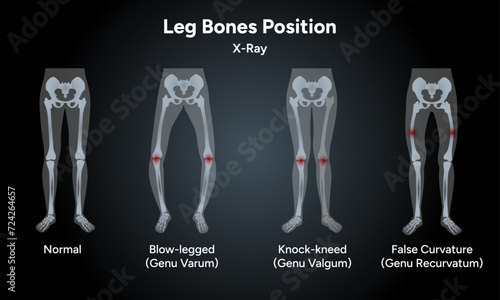 Leg bones position Blowlegged knock-kneed in x-ray