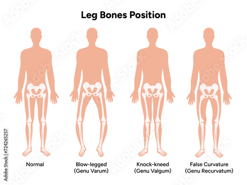 Leg bones position Blowlegged knock-kneed face curvature