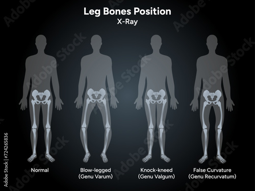 Leg bones position Blowlegged knock kneed face curvature in x-ray photo
