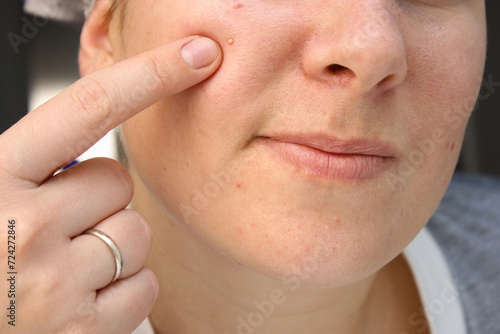 Close up of caucasian woman's face with scars, acne skin problems photo