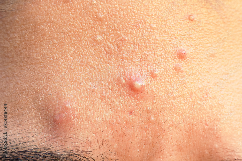 Close up face of teenage guy with Acne on the forehead and problem skin. Hormonal acne