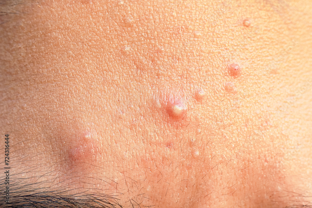 Fototapeta premium Close up face of teenage guy with Acne on the forehead and problem skin. Hormonal acne