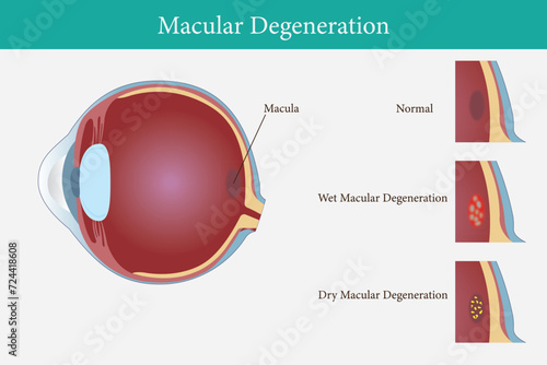 Age-related macular degeneration.Eye vision disorder. vector eps 10