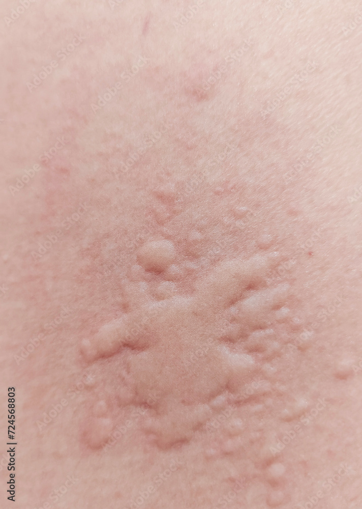 Red rash on the skin caused by allergies.