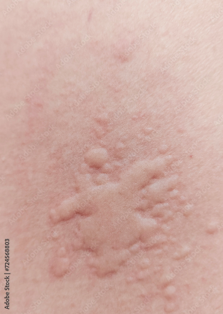 Red rash on the skin caused by allergies. Red rash on the skin caused by allergies.