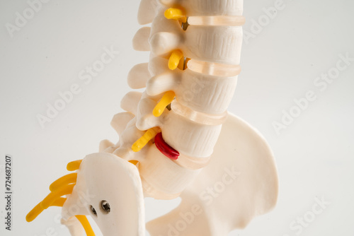 Lumbar spine displaced herniated disc fragment, spinal nerve and bone. Model for treatment medical in the orthopedic department. photo