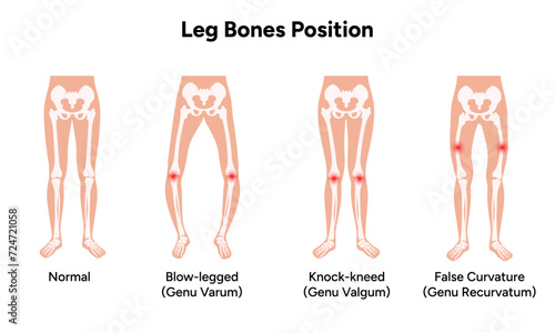 Leg bones position Blowlegged knock kneed face curvature