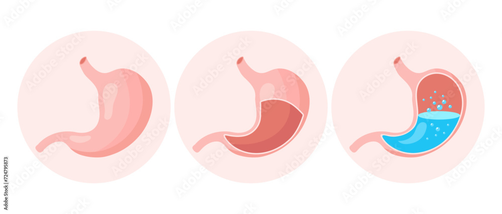 Healthy empty and full human stomach, medical icons set. Gastritis, ulcer, abdominal pain, bloating. Anatomy of the digestive system. Vector Healthy empty and full human stomach, medical icons set. Gastritis, ulcer, abdominal pain, bloating. Anatomy of the digestive system. Vector