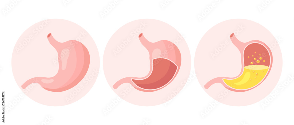 Healthy and unhealthy, empty and full human stomach in flat style, icons set. Nutrition, stomach pain, bloating. Anatomy of the digestive system. Vector