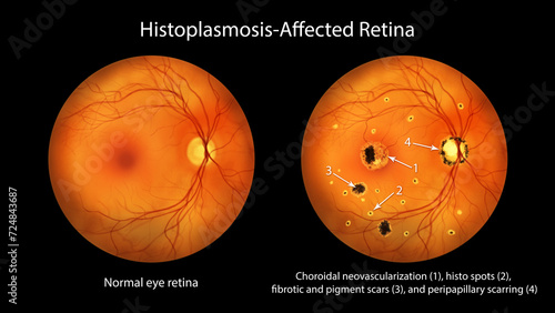 Retina in Ocular Histoplasmosis Syndrome, illustration photo