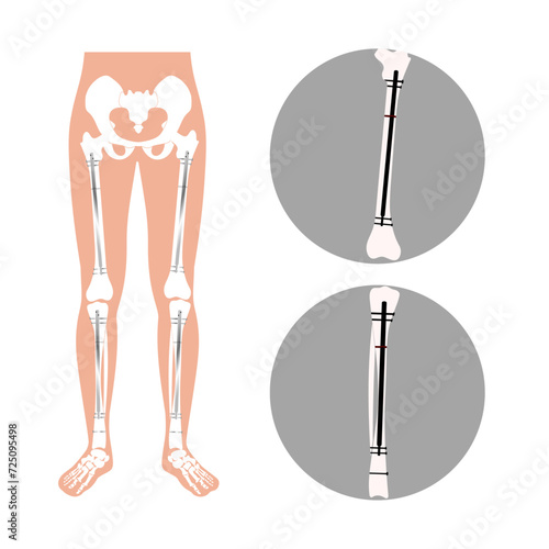 internal nail in an adult femur