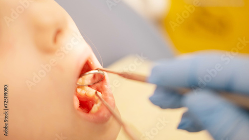 Close up cropped photo of curing healing operating teeth tooth, filling mouth cavity against caries decay dentist orthodontist in dental clinic. Stomatology concept.