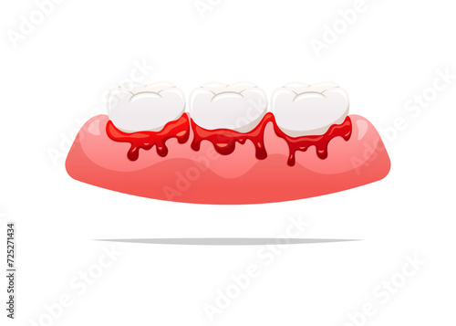 Bleeding teeth and gums vector isolated on white background.