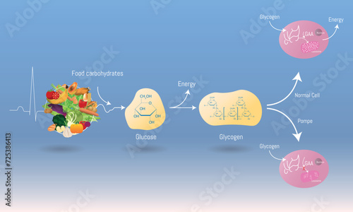Infographic of Pompe disease chemical process