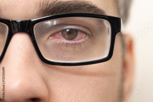 Man in glasses with a red eye Close-up photo  photo